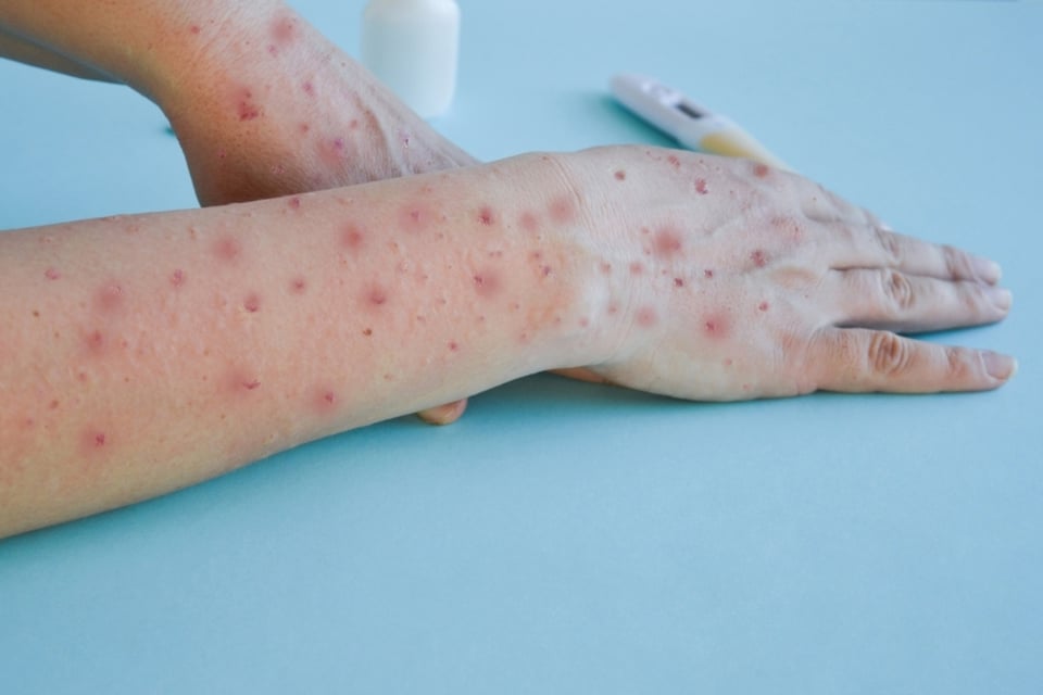 Virus del mono síntomas, Contagio, Diagnóstico, Prueba, Laboratorios