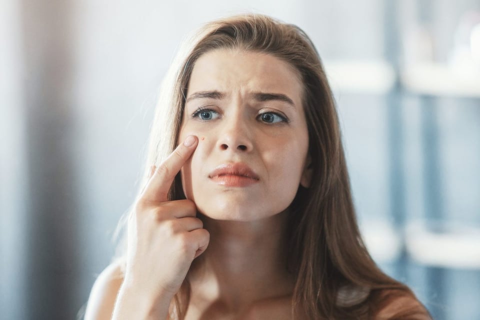 granos en la cara, How to Remove a Pimple Fast and Without Leaving a Mark