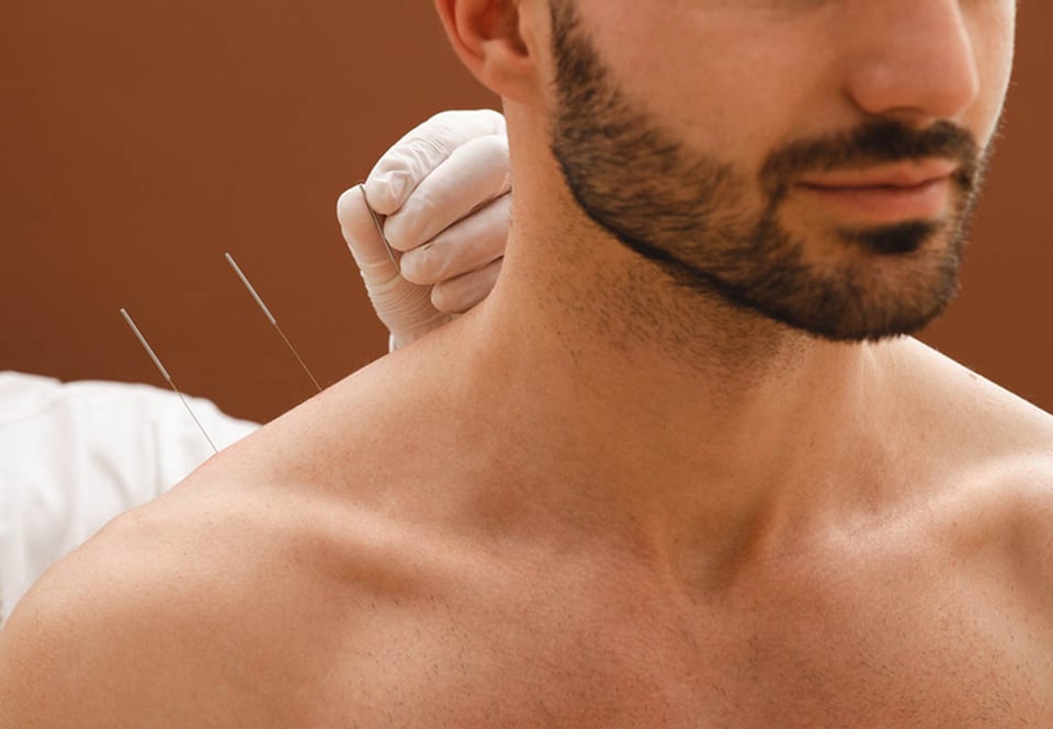Needles, acupuncture, shoulder, natural medicine, MundoNOW