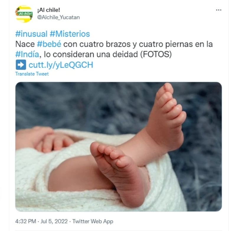 Baby born with four arms and legs
