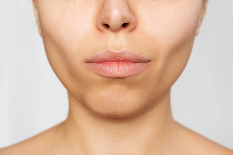 cosmetology, plastic surgery, buccal fat removal, MundoNOW