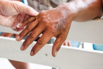 A rise in leprosy cases in the US