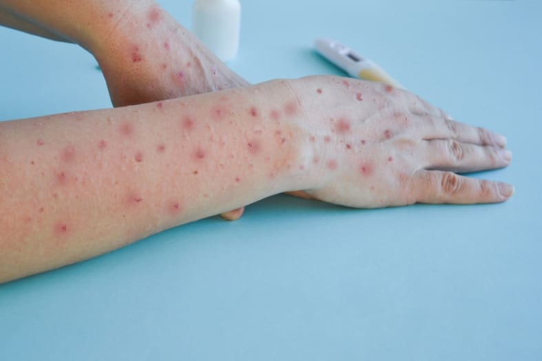 CDC releases map of monkeypox cases