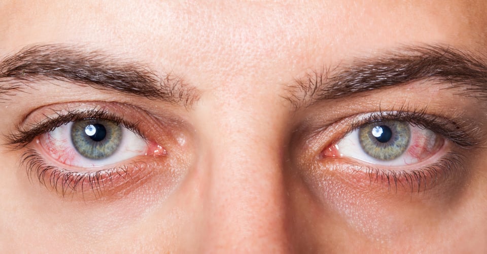 eye infection eye infection