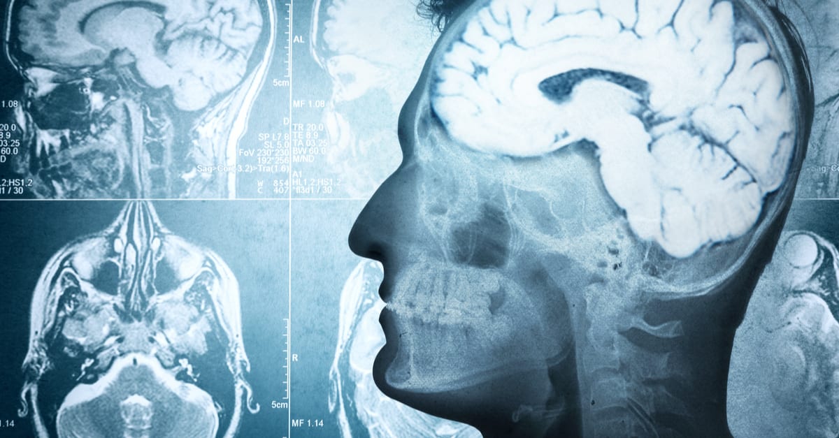 Brain aneurysm symptoms: 12 signs you need to go to the ER ASAP
