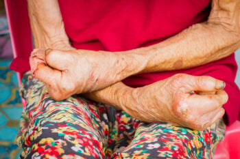 The CDC has announced a rise in leprosy cases