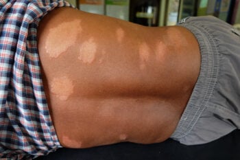 Leprosy