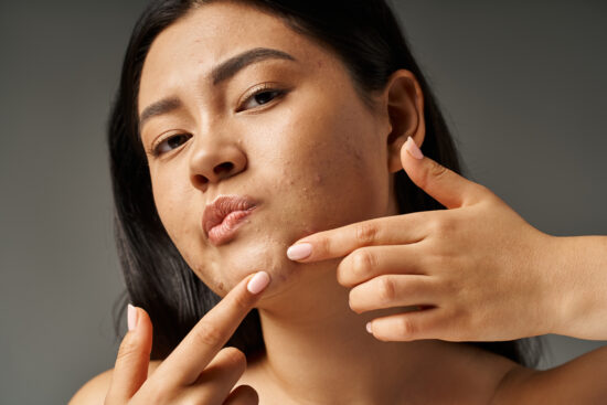 Say Goodbye to Pimples! Easy Home Remedies for Clear, Glowing Skin